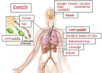 4 Evre Akciğer Kanseri Belirtileri ve Tedavisi