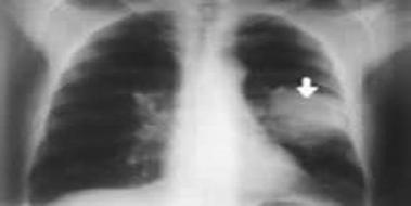 Akciğer Kanseri Beyin Metastazı Ölüm